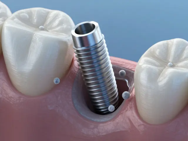 Jak dlouho vydrží zubní implantáty? Skutečné číslo a co na to ovlivňuje