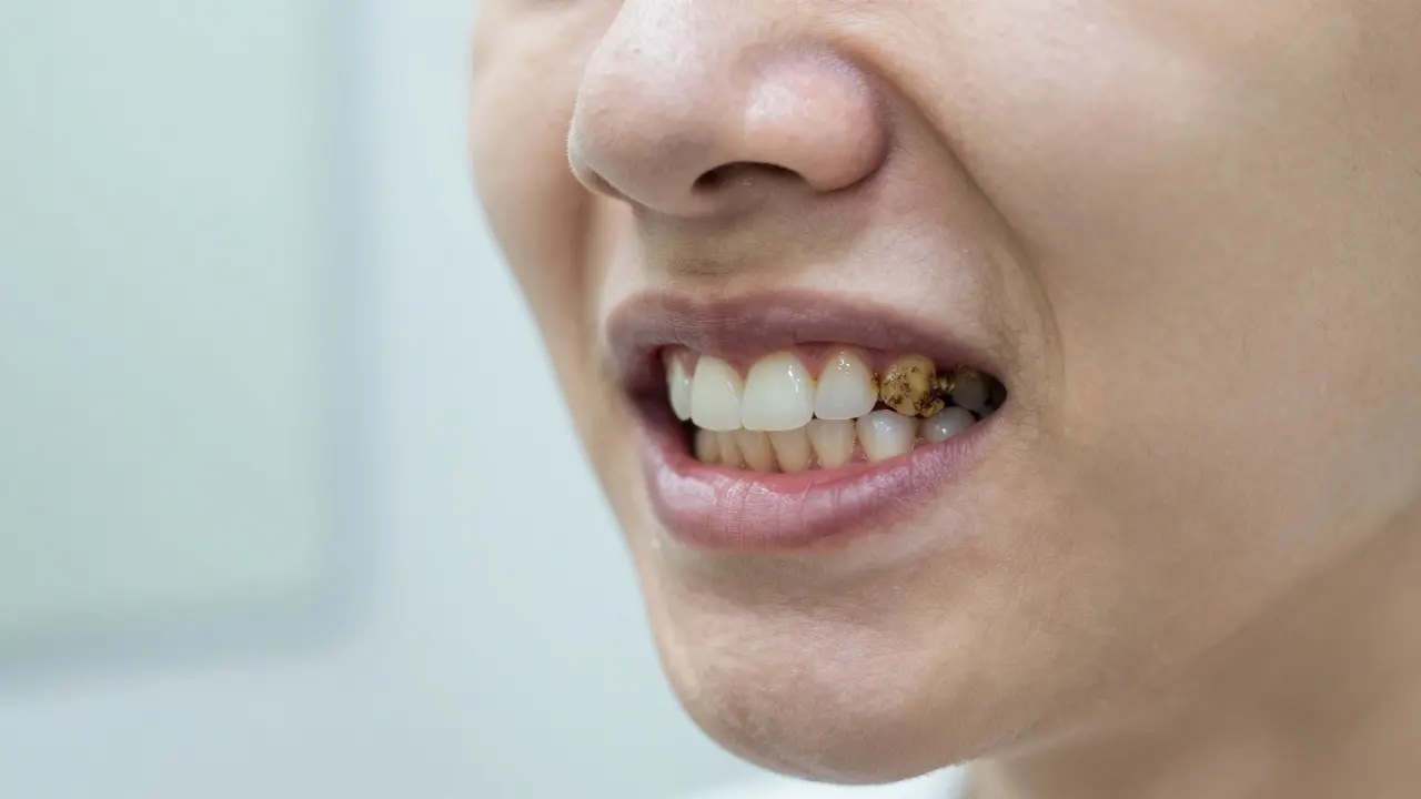 Jak se zbavit zubního kamene: Fungují domácí metody a bělicí pásky?