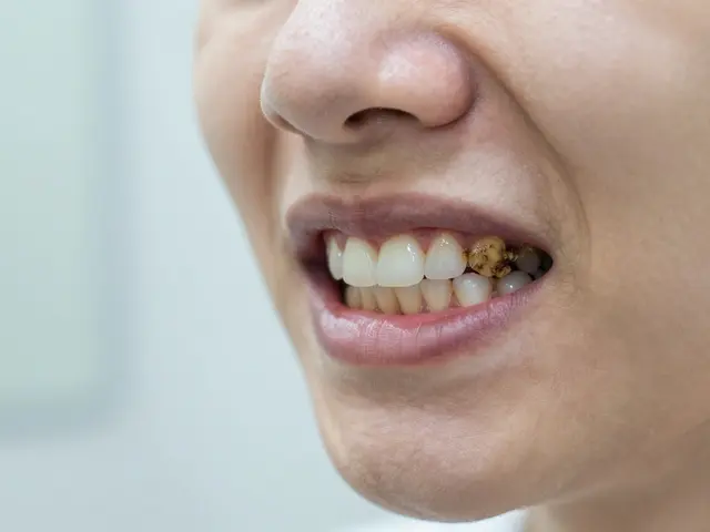 Jak se zbavit zubního kamene: Fungují domácí metody a bělicí pásky?