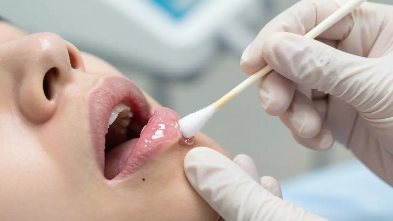 Aplikace anestetického gelu na dásně pomocí vatového tamponu