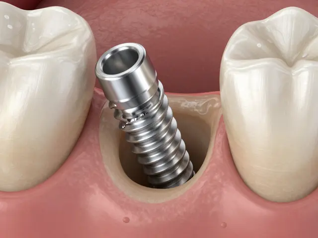 Proč jsou zubní implantáty považovány za nejlepší řešení pro chybějící zuby?